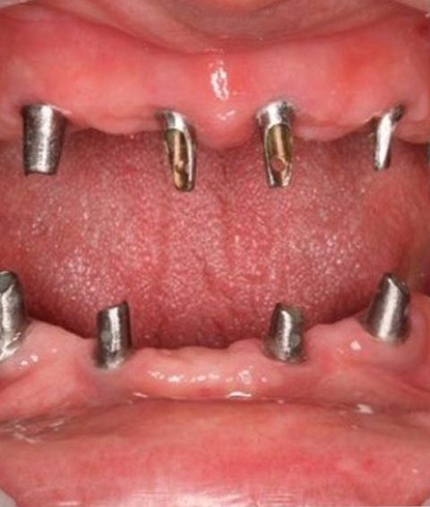 dental-implants-reading-PA